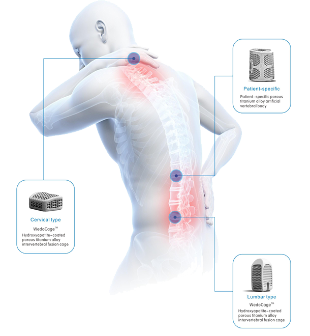 3D Printed Porous Spinal Titanium Fusion Cage with Bioactive Coating